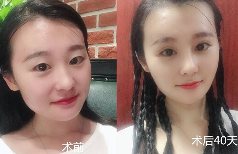 重庆做双眼皮哪里好？超声波双眼皮让你获得无痕大美眼！583