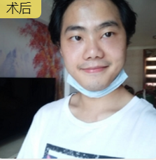 重庆去眼袋哪里棒？重庆超雅美容医院超 声 波去眼袋