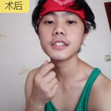 重庆去眼袋哪里棒？重庆超雅美容医院超 声 波去眼袋