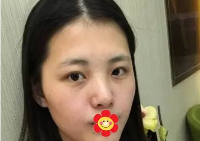 重庆做双眼皮哪里好？就选重庆超雅医疗美容研究所！013