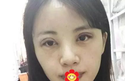 重庆做双眼皮哪里好？就选重庆超雅医疗美容研究所！013