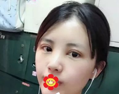 重庆做双眼皮哪里好？就选重庆超雅医疗美容研究所！013