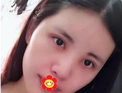 重庆做双眼皮哪里好？就选重庆超雅医疗美容研究所！013