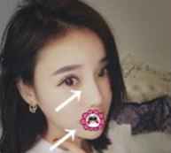 重庆玻尿酸填充哪家强？来看超雅不开刀下巴延长术！