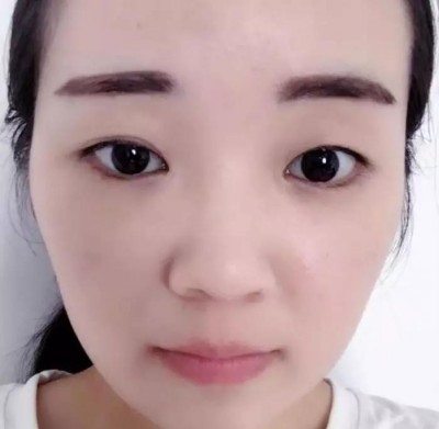 重庆超雅超声波双眼皮，让我看上去也会很有精神气哦399