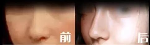 重庆超雅玻尿酸塑形（下巴延长术）让你依旧美！948