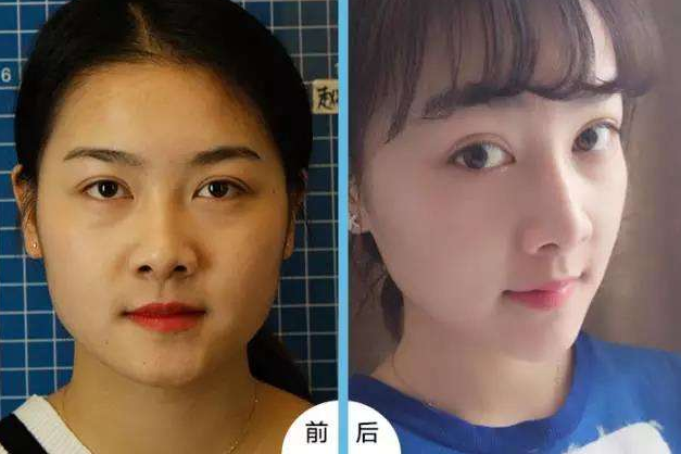 重庆超雅玻尿酸塑形（下巴延长术）让你依旧美！948