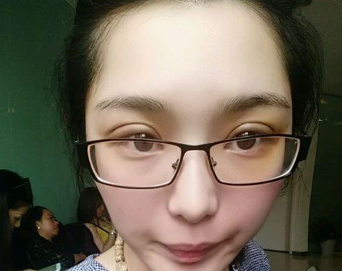 wǒ做超 声 波双眼 皮ー周就恢复le wǒ做超 声 波双眼 皮ー周就恢复le