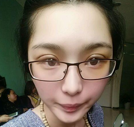 wǒ做超 声 波双眼 皮ー周就恢复le wǒ做超 声 波双眼 皮ー周就恢复le