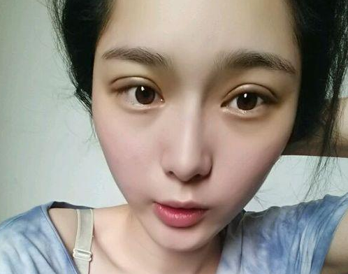 wǒ做超 声 波双眼 皮ー周就恢复le wǒ做超 声 波双眼 皮ー周就恢复le