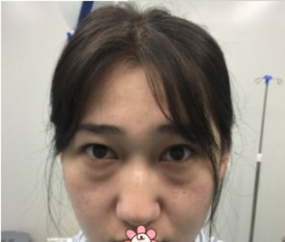 对下一段恋情好期待呀，这都感恩于超声波去眼袋！853