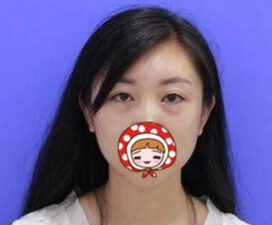 重庆去眼袋手术美容整形医院我选超雅!397 重庆去眼袋手术美容整形医院我选超雅!397