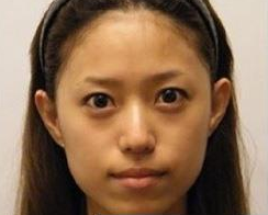 重庆超雅自体脂肪丰面,让脸蛋变美了!230 重庆超雅自体脂肪丰面,让脸蛋变美了!230