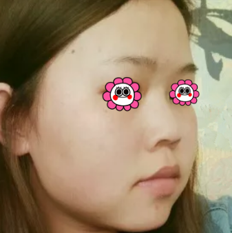 在重庆超雅做超声波瘦脸,让你喜获精致脸425 在重庆超雅做超声波瘦脸,让你喜获精致脸425