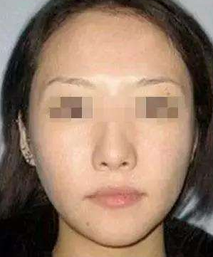 重庆超雅自体脂肪丰面让你美回少女感 重庆超雅自体脂肪丰面让你美回少女感