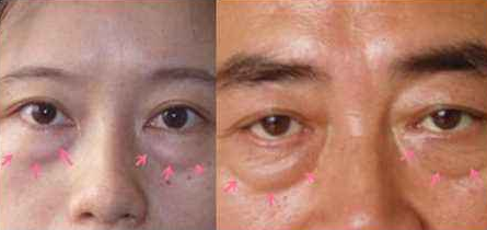 重庆超雅超声波去眼袋手术给你想要的“眼”值！365