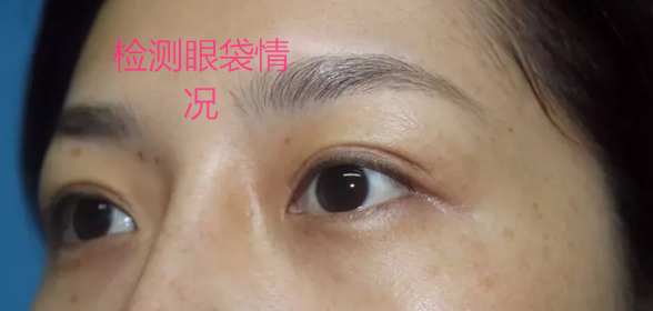 重庆超雅超声波去眼袋手术给你想要的“眼”值！365