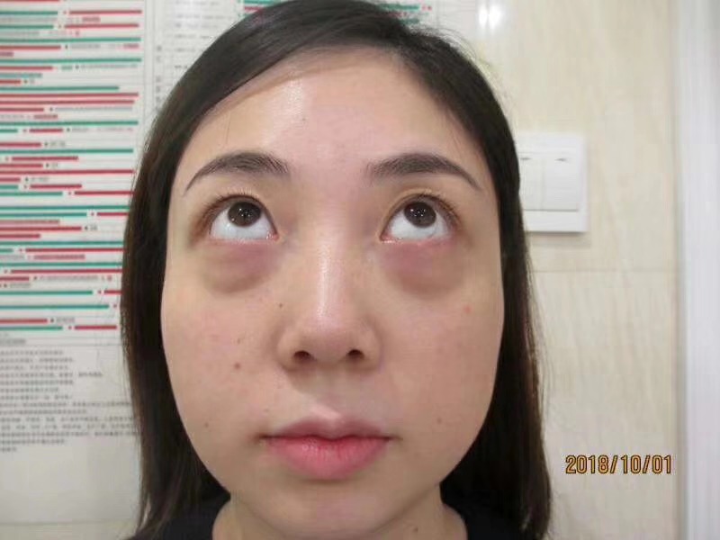 做了超声波去眼袋手术招来桃花运584 做了超声波去眼袋手术招来桃花运584