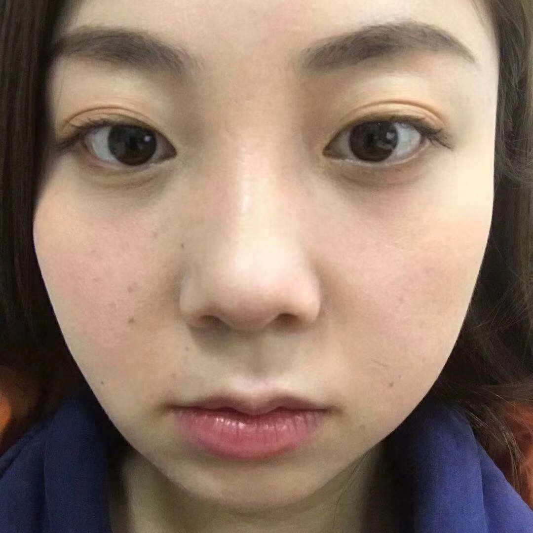 做了超声波去眼袋手术招来桃花运584 做了超声波去眼袋手术招来桃花运584