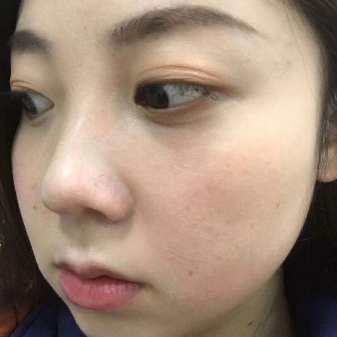 做了超声波去眼袋手术招来桃花运584 做了超声波去眼袋手术招来桃花运584