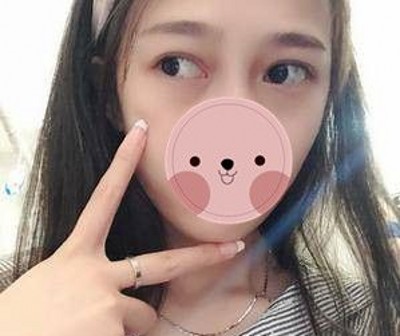 重庆超雅超 声 波去眼袋,真得shìshì个明智之举 重庆超雅超 声 波去眼袋,真得shìshì个明智之举