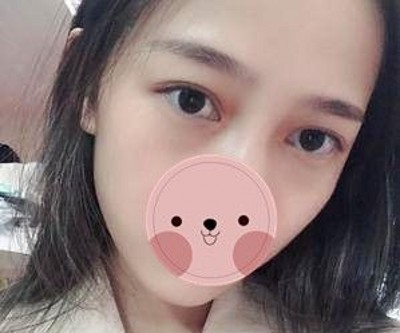 重庆超雅超 声 波去眼袋,真得shìshì个明智之举 重庆超雅超 声 波去眼袋,真得shìshì个明智之举