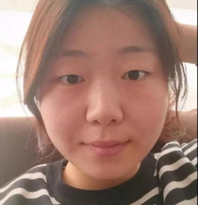 重庆超雅超 声 波双眼 皮，气质美女就这么简单