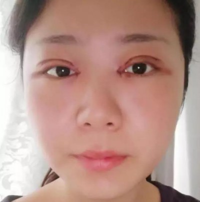 重庆超雅超 声 波双眼 皮，气质美女就这么简单