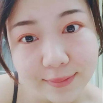 重庆超雅超 声 波双眼 皮，气质美女就这么简单