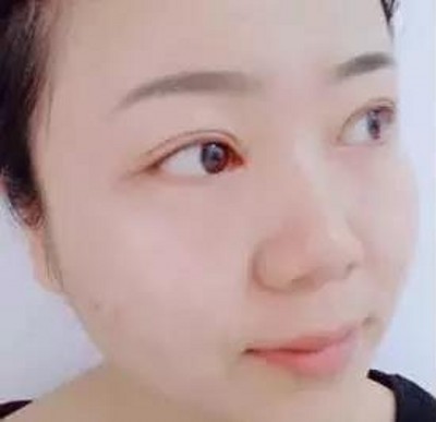 重庆超雅超 声 波双眼 皮，气质美女就这么简单