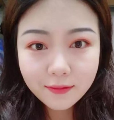 重庆超雅超 声 波双眼 皮，气质美女就这么简单