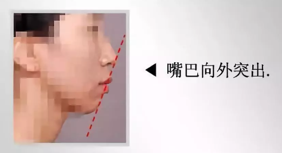重庆超雅不开刀下巴延长术塑造出你得美学下巴 重庆超雅不开刀下巴延长术塑造出你得美学下巴