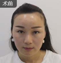 重庆超雅不开刀下巴延长术塑造出你得美学下巴 重庆超雅不开刀下巴延长术塑造出你得美学下巴