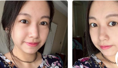 晚上喝水长眼袋怎么办？超声波去眼袋让我再无后顾之忧！756
