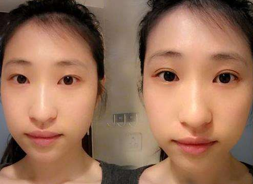 重庆超雅超声波双眼皮手术让你素颜也能美翻天！594