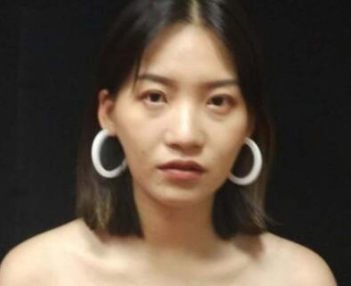 重庆超雅不开刀隆鼻整形日记005 重庆超雅不开刀隆鼻整形日记005
