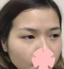 重庆超雅超声波双眼皮手术点亮了眼睛628 重庆超雅超声波双眼皮手术点亮了眼睛628