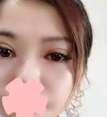 重庆超雅超声波双眼皮手术点亮了眼睛628 重庆超雅超声波双眼皮手术点亮了眼睛628