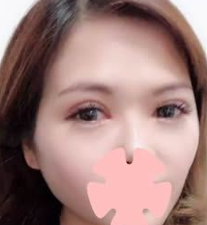 重庆超雅超声波双眼皮手术点亮了眼睛628 重庆超雅超声波双眼皮手术点亮了眼睛628