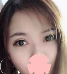 重庆超雅超声波双眼皮手术点亮了眼睛628 重庆超雅超声波双眼皮手术点亮了眼睛628