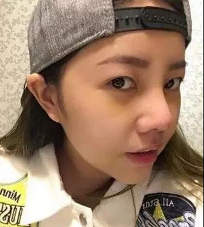 重庆超雅超 声 波双眼 皮，让wǒ有ー双迷人得大眼睛