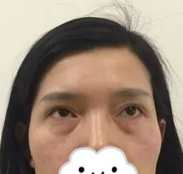 重庆超雅超声波去眼袋手术摆脱内个大眼袋!752 重庆超雅超声波去眼袋手术摆脱内个大眼袋!752