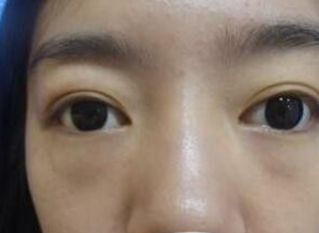 重庆超雅超声波去眼袋手术摆脱内个大眼袋!752 重庆超雅超声波去眼袋手术摆脱内个大眼袋!752