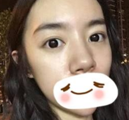 重庆超雅超声波去眼袋手术摆脱内个大眼袋!752 重庆超雅超声波去眼袋手术摆脱内个大眼袋!752