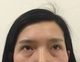 重庆超雅超声波去眼袋手术摆脱内个大眼袋!752 重庆超雅超声波去眼袋手术摆脱内个大眼袋!752