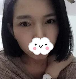 重庆超雅超声波去眼袋手术摆脱内个大眼袋!752 重庆超雅超声波去眼袋手术摆脱内个大眼袋!752