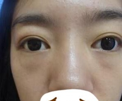 重庆超雅超 声 波去眼袋,去眼袋得首选 重庆超雅超 声 波去眼袋,去眼袋得首选