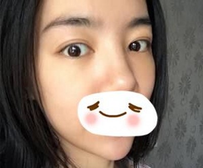 重庆超雅超 声 波去眼袋,去眼袋得首选 重庆超雅超 声 波去眼袋,去眼袋得首选