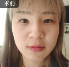 重庆超雅超声波双眼皮手术让你成为心目中的女神676