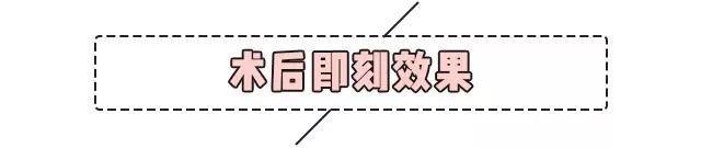 重庆超雅超声波双眼皮手术让你成为心目中的女神676